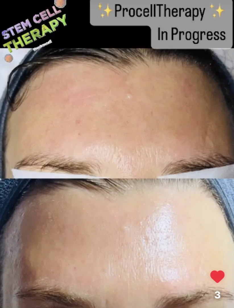 A woman 's face before and after using the derma roller.